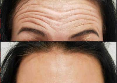 botox before and after