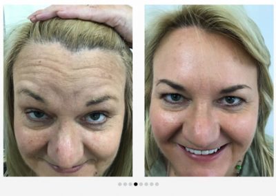 Frown Lines Before and After Botox