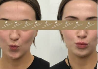lip fillers