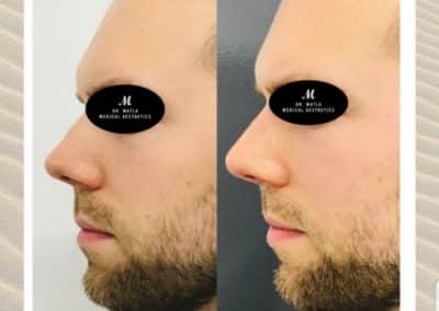 rhinoplasty - nonsurgical nose job