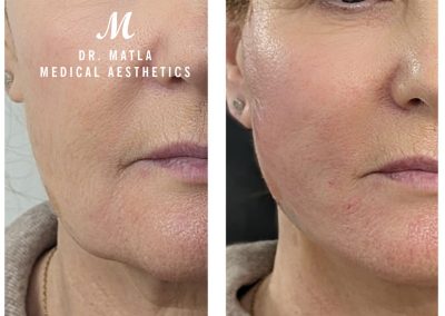 PDO Threadlift Newcastle