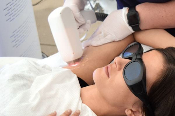 LASER HAIR REMOVAL NEWCASTLE