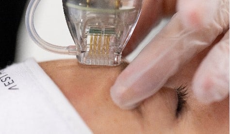  Advanced Radiofrequency Microneedling Newcastle