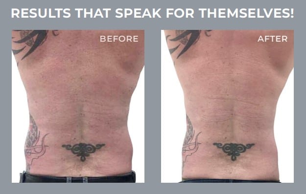 3d lipo results male