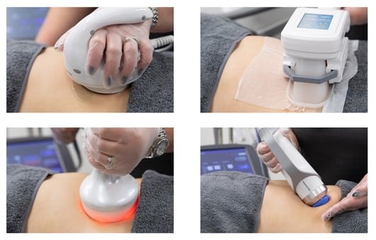ADVANCED RADIOFREQUENCY MICRONEEDLING (1)