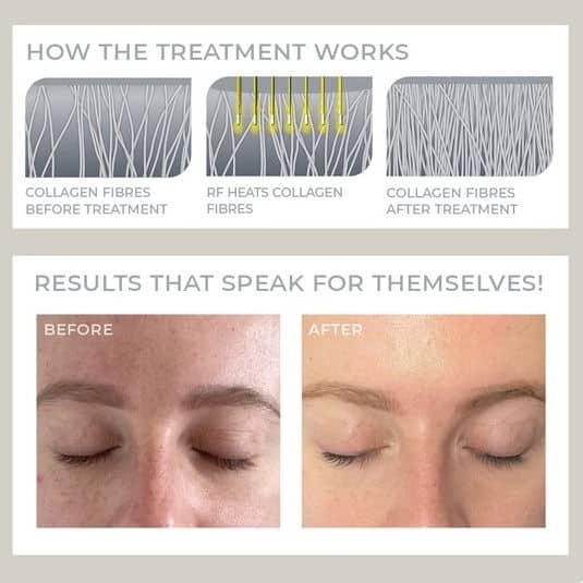treatment collagen fibres