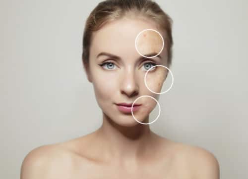 Chemical Peels Near Durham