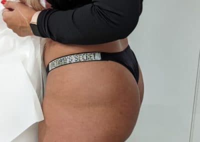 Hip Dip Filler Before Image
