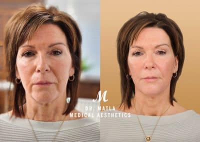 Face Lift Dr Matla