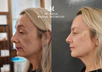 Non Surgical Face Lift Dr Matla