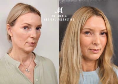 PDO Threadlift Newcastle