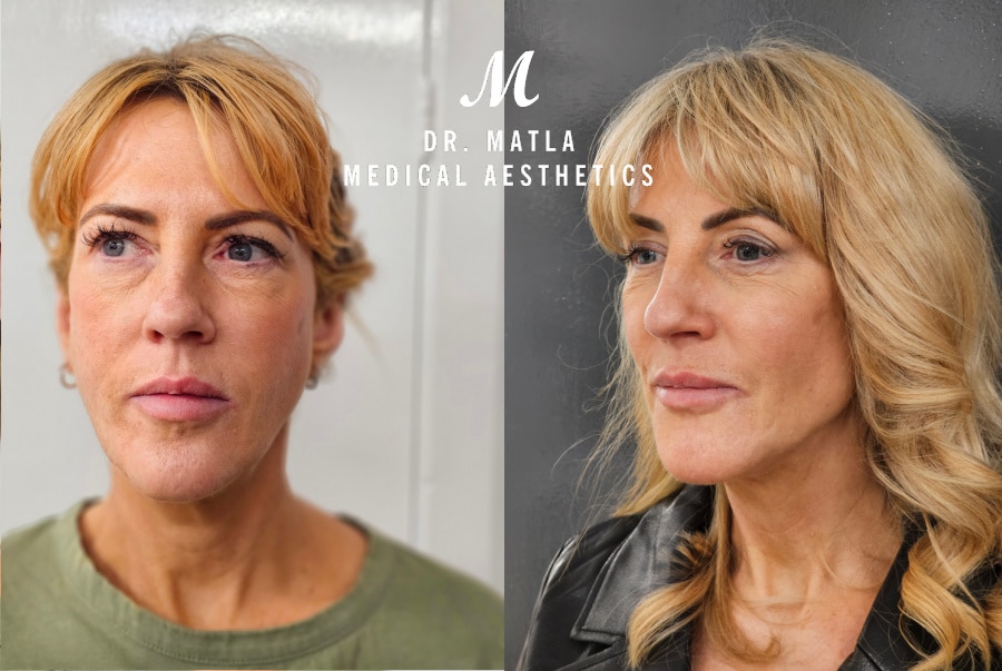 Before and after Radiesse dermal filler treatment demonstrating natural facial rejuvenation, enhanced contours and a firmer, more youthful appearance
