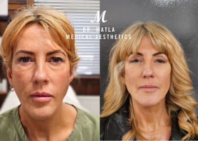 Radiesse Dermal Fillers Before and After