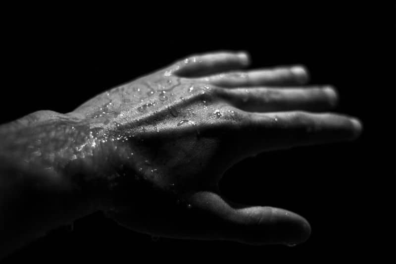 Close-up of a hand with visible perspiration, illustrating excessive sweating caused by palmar hyperhidrosis
