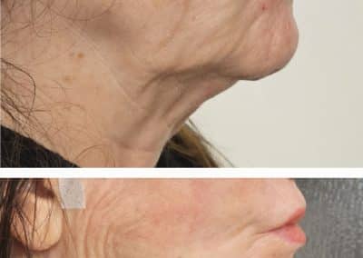 Aptos Thread Lift Before and After