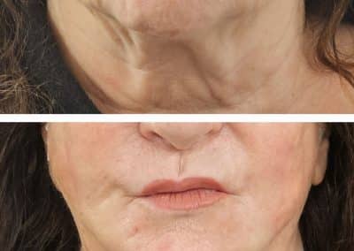 Aptos Thread Lift Before and After