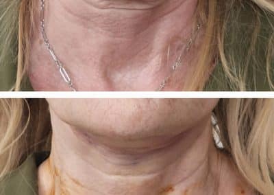 Aptos Thread Lift Before and After