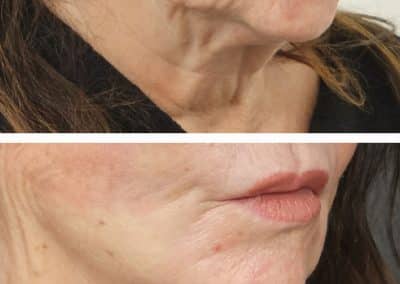 Aptos Thread Lift Before and After (4)