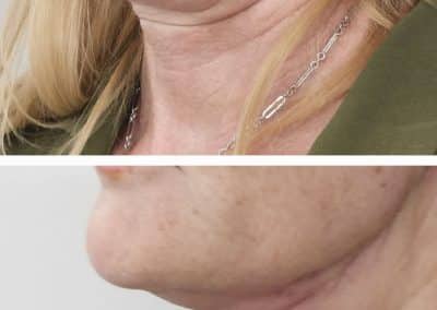 Aptos Thread Lift Before and After