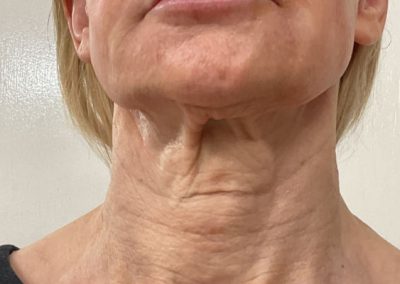 Neck Lift Before