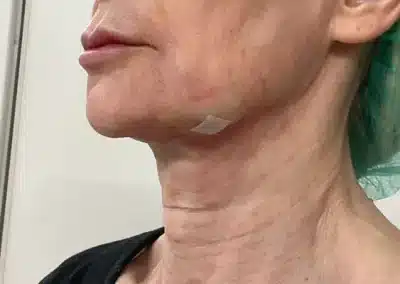 Neck Lift After side