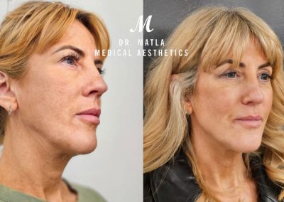 Radiesse Dermal Fillers Jowl Lift