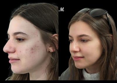 Acne Before and After Treatment Newcastle (1)
