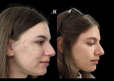 Acne Before and After Treatment Newcastle (1)