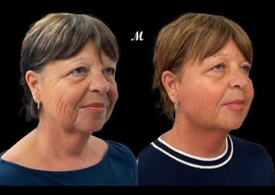 Aptos Threadlift Before and After (1)