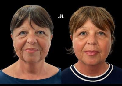 Aptos Threadlift Before and After