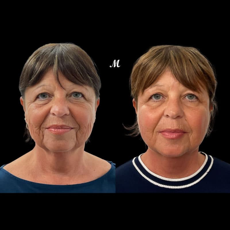 Aptos Threadlift Before and After
