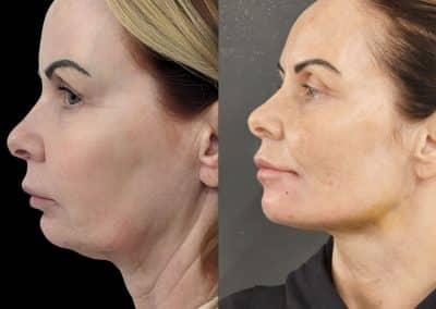 Face & Neck Thread Lift – Before & After