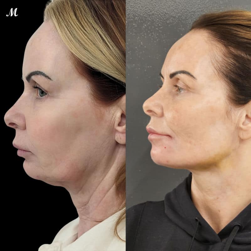 Face & Neck Thread Lift – Before & After