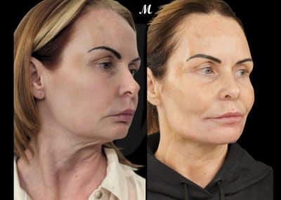 Face & Neck Thread Lift – Before & After