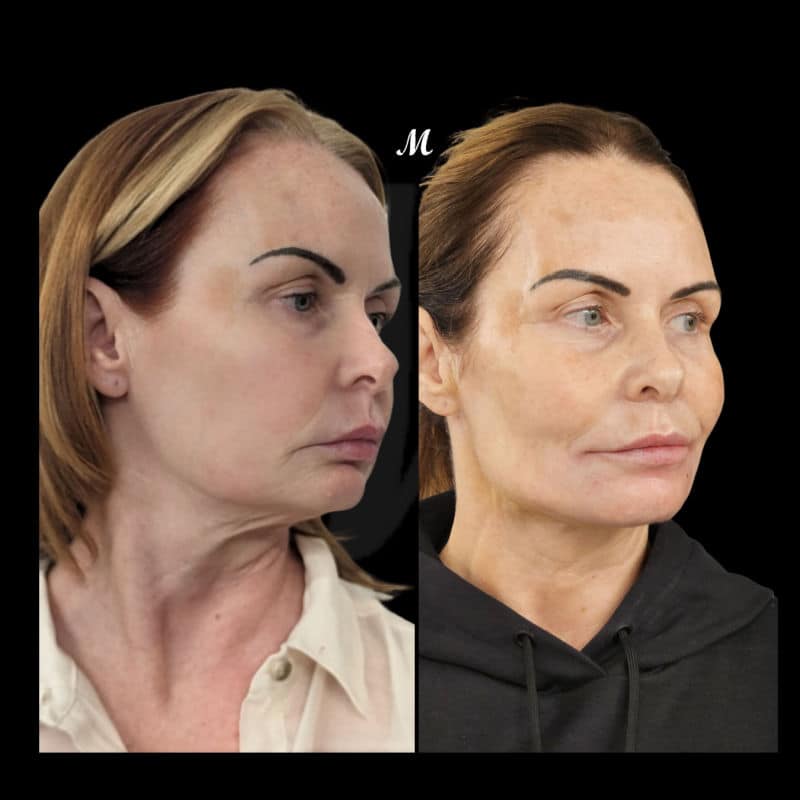 Face & Neck Thread Lift – Before & After