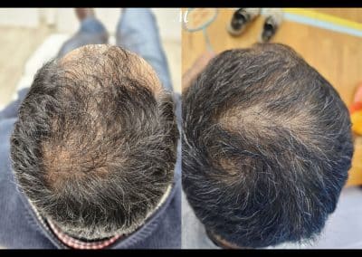 Hair Loss Treatment Before and After (1)