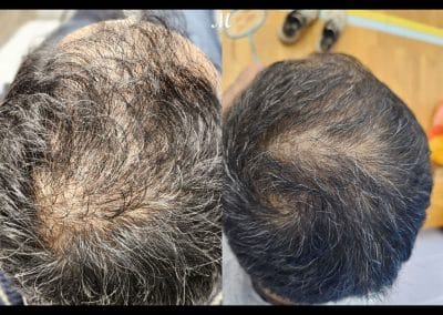 Hair Loss Treatment Before and After