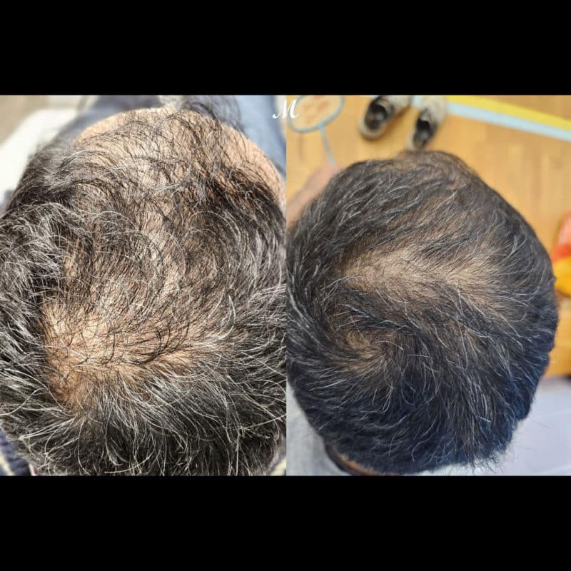 Hair Loss Treatment 
