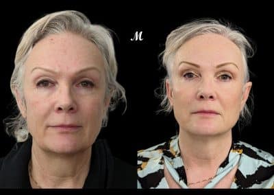 Liquid Face Lift Before and After (1)