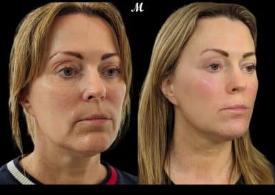 Liquid Face Lift Before and After