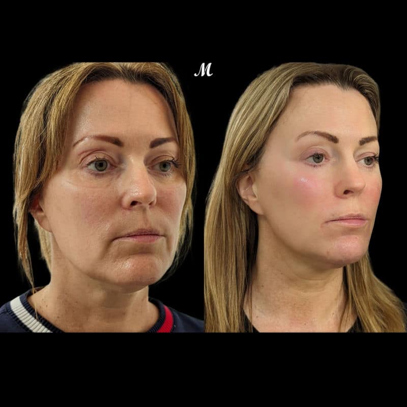 Liquid Face Lift Before and After
