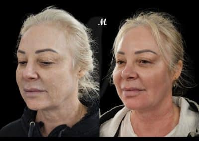 Non Surgical Face Lift Before and After