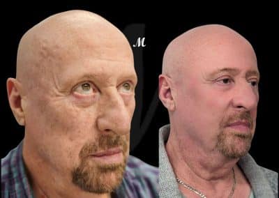 Non Surgical Face Lift Before and After