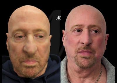 Non Surgical Face Lift Before and After