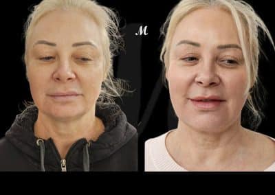 Non Surgical Face Lift Before and After