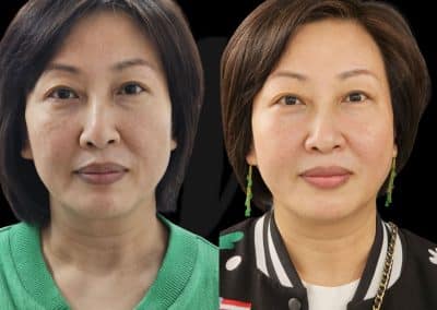 PDO Thread Lift Before and After Dr Matla