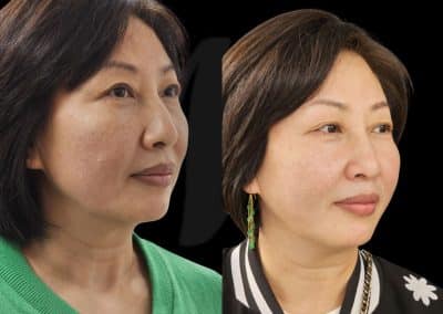PDO Thread Lift Before and After Dr Matla