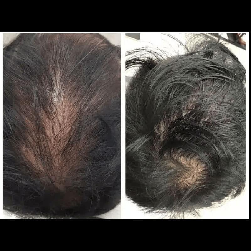 PRP Hairloss Treatment For men and women 