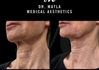 Neck Thread Lift Newcastle upon Tyne