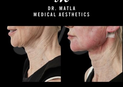 Neck Thread Lift Newcastle